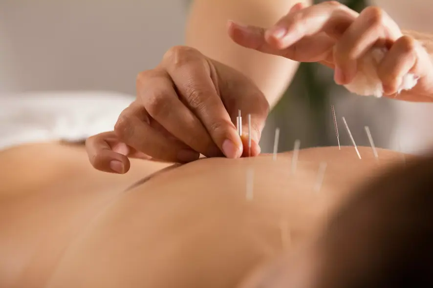 Akupunktur-Behandlung mit Nadeln im Rückenbereich