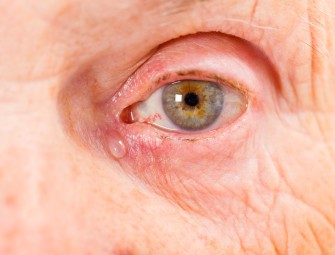 Tränende Augen-Augenleiden im Alter und was dagegen hilft